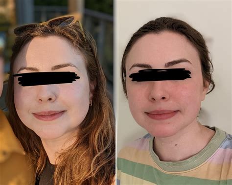 buccal fat removal norge